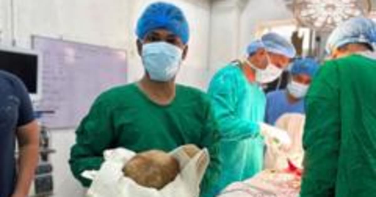 डॉक्टरों ने एक शख़्स के ब्लैडर से 3.1 किलोग्राम की पथरी निकाली