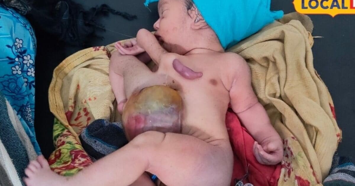 छतरपुर में महिला ने 4 हाथ और 4 पैर वाले बच्चों को दिया जन्म, देखते ही सहम गए परिजन, लोगों का लगा तांता