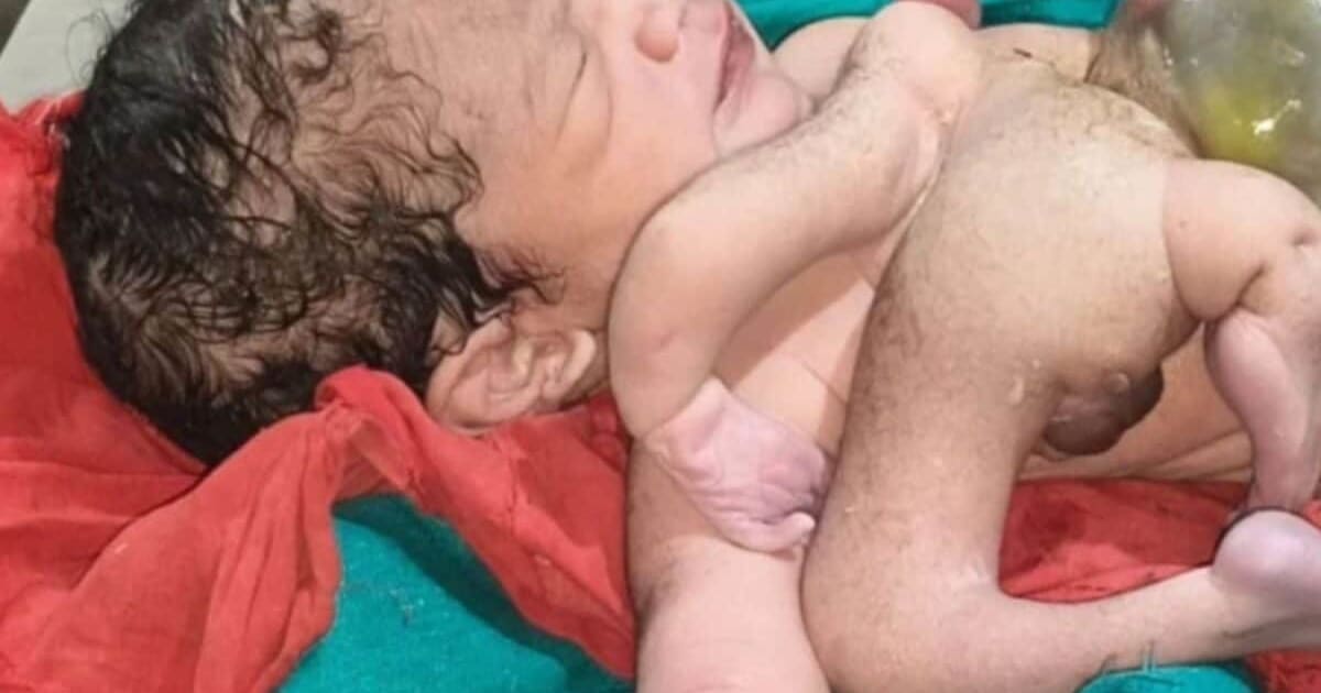 छतरपुर में 4 हाथ-पैर वाले बच्चे का जन्म, अतिरिक्त धड़ भी जुड़ा, देख हैरान हुए लोग, जानिए डॉक्टर ने क्या कहा?