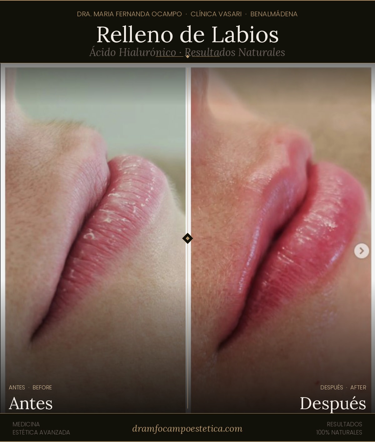 Lip Fillers with Hyaluronic Acid in Benalmadena: Natural Results, Duration, and Price