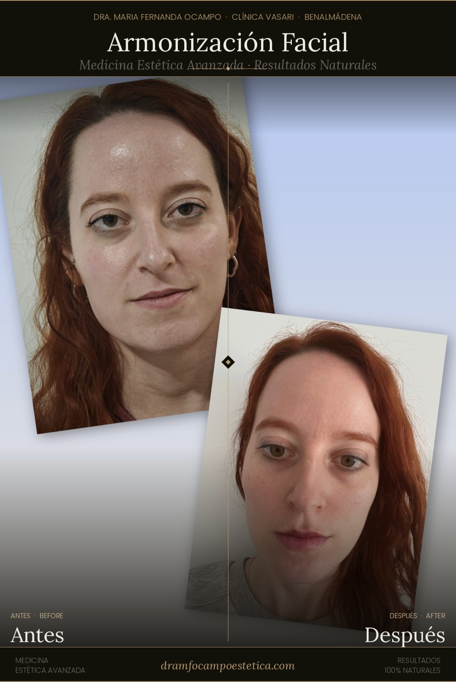 Armonización Facial en Benalmádena: equilibrio, frescura y naturalidad