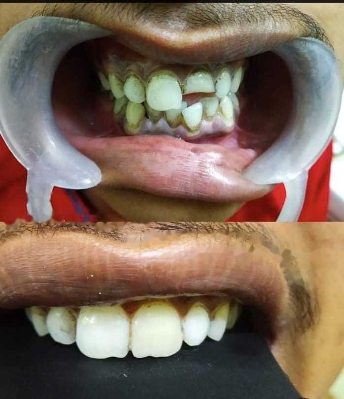 Before and after dental treatment