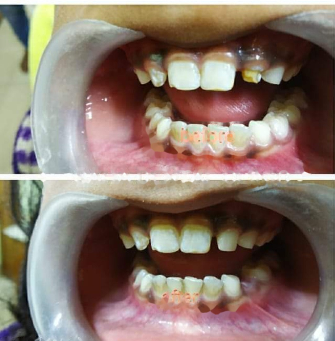 Before and after dental treatment