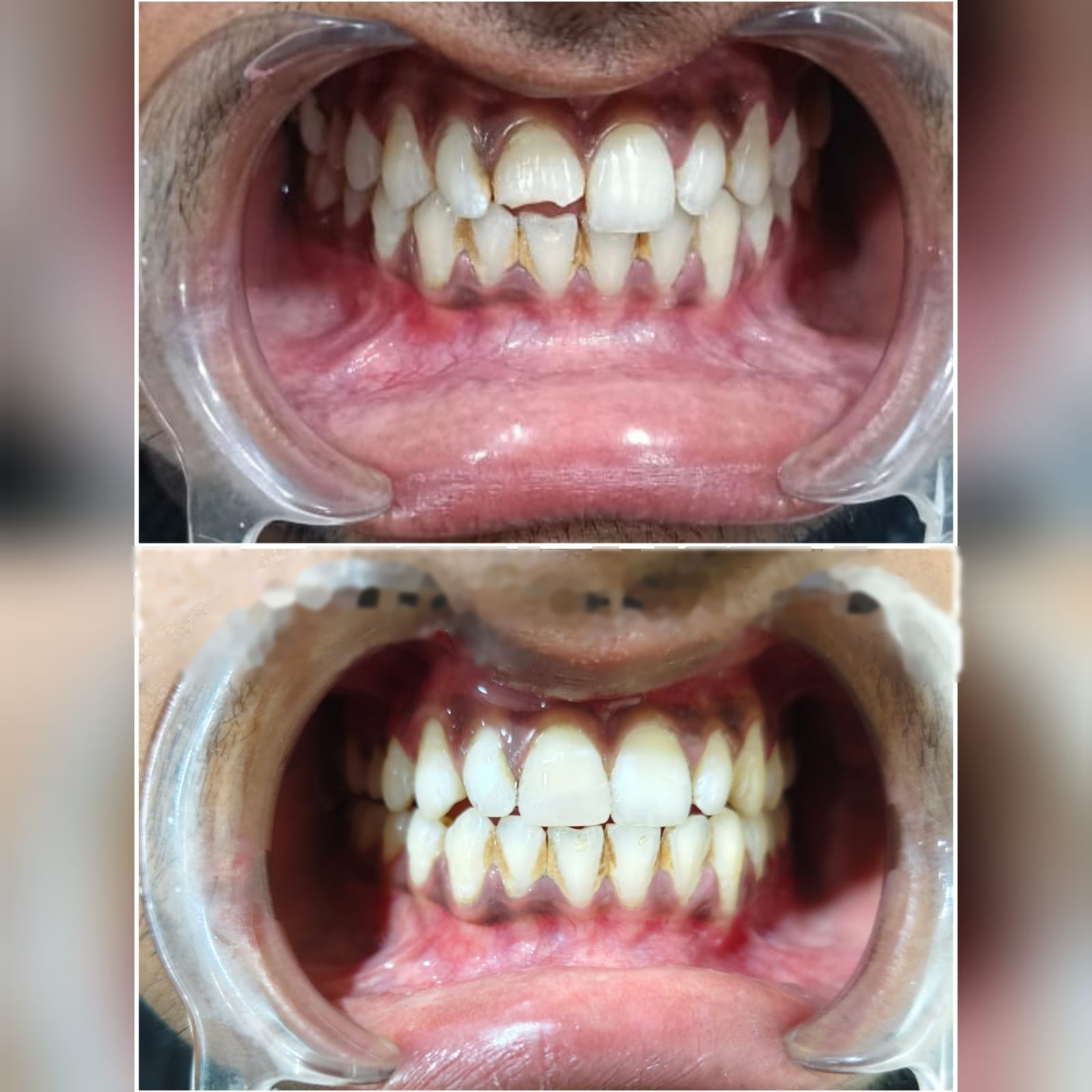 Before and after dental treatment