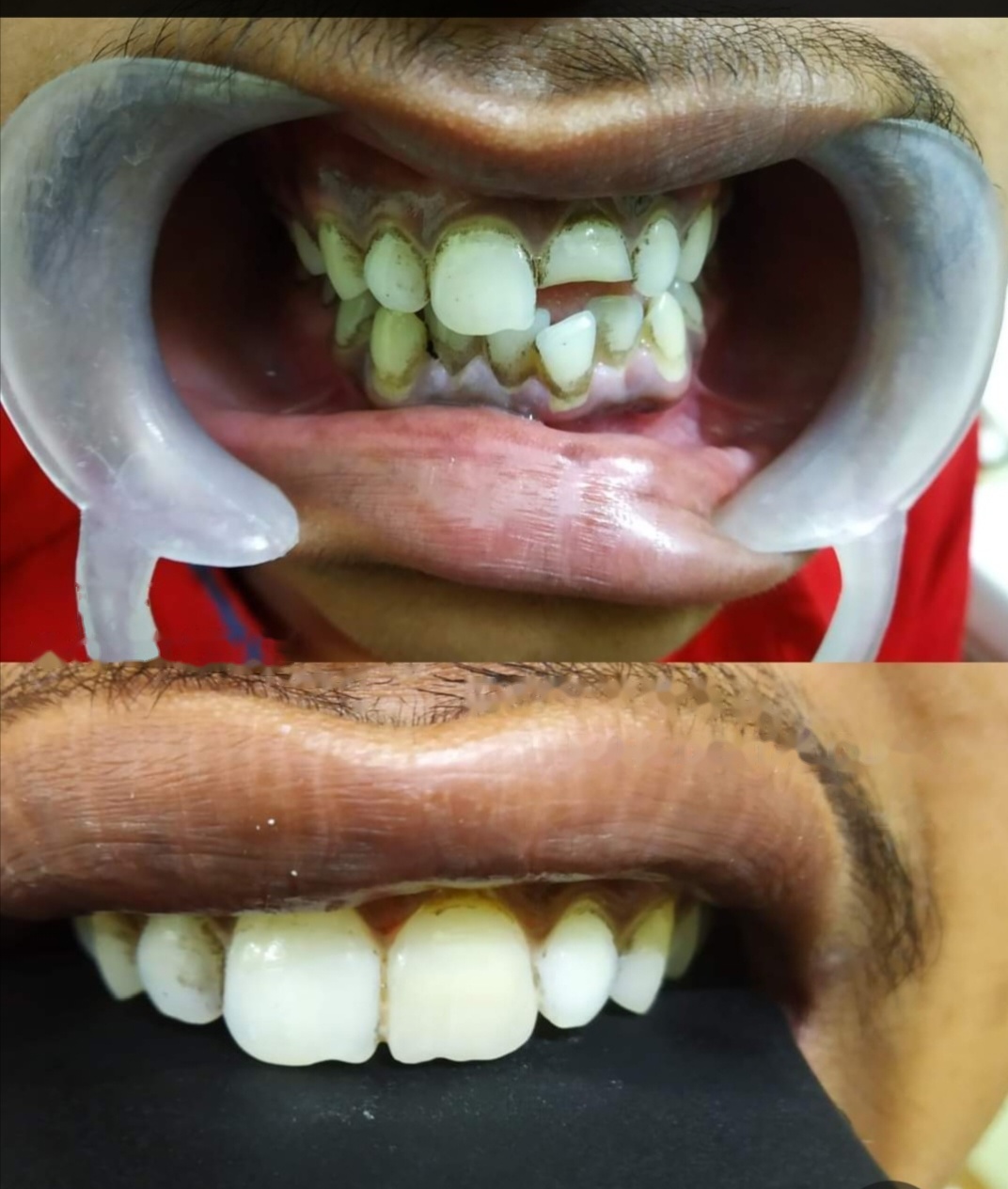 Before and after dental treatment