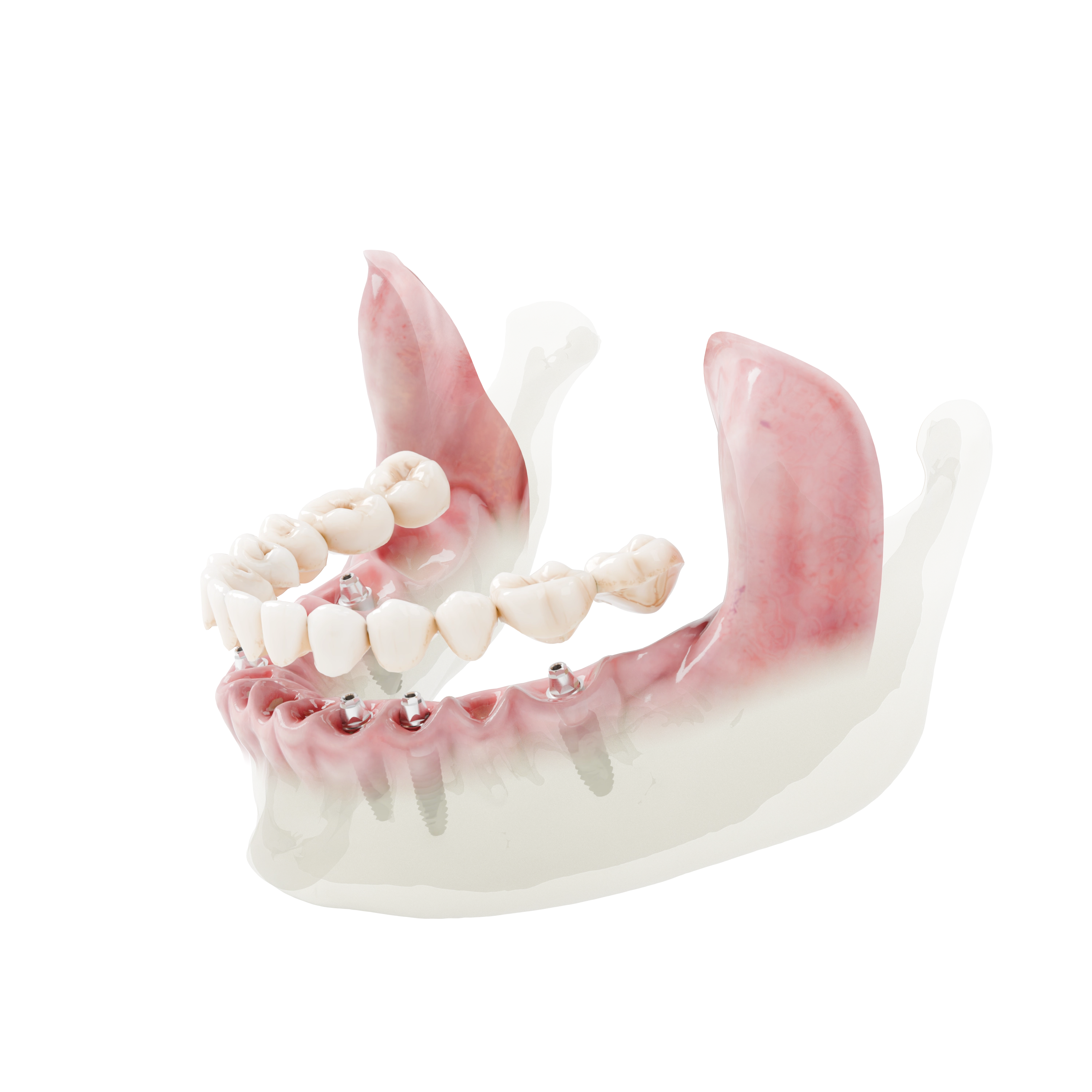 Full Arch protez entegrasyonu — köprü ve bağlantı tasarımı