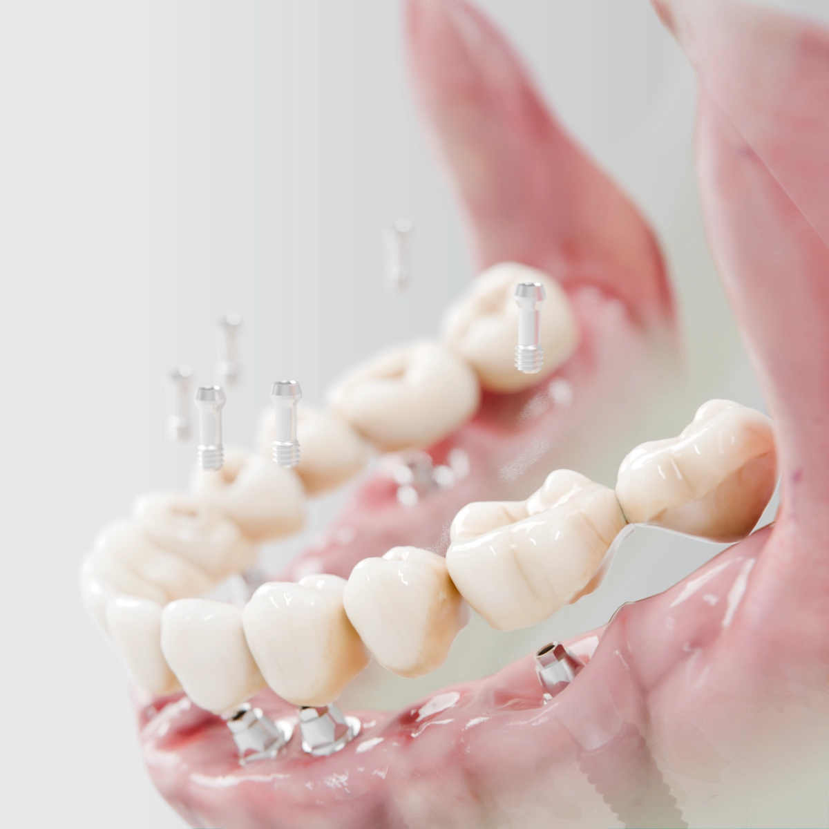 DIO NAVI Full Arch rehber sistemi — dijital planlama ve bileşenler