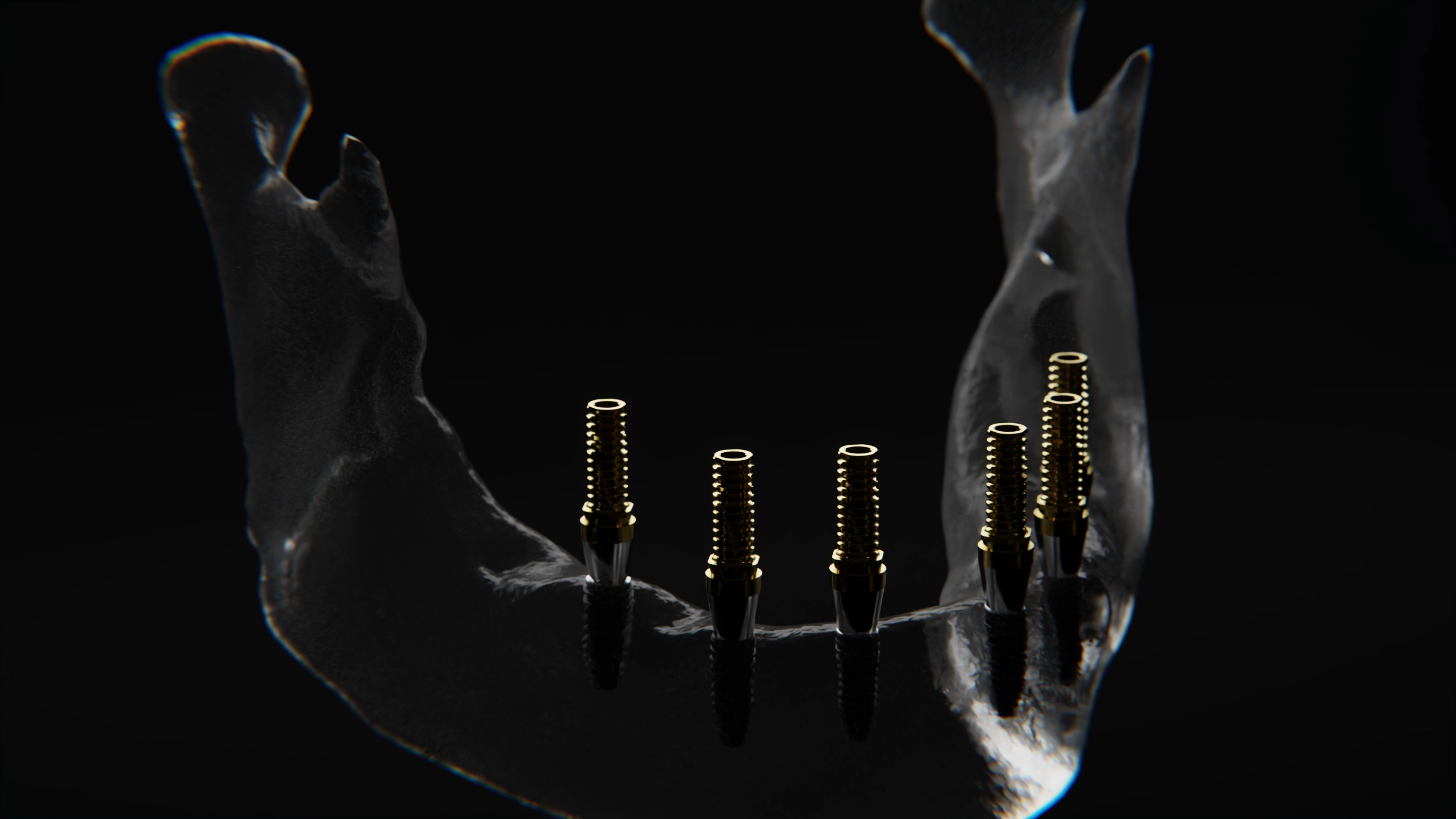 Full Arch teknik derinlik — implant ve çene planlama görselleştirmesi