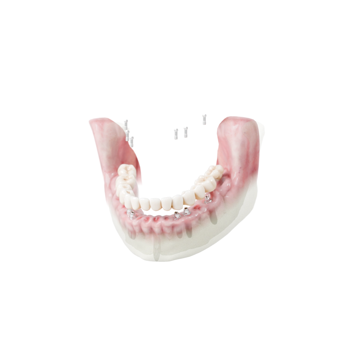 Full Arch teknik derinlik — anatomi ve protez ilişkisi