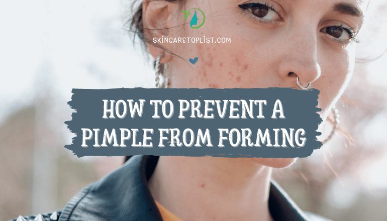 How To Prevent A Pimple From Forming – Tips To Eliminate Acne