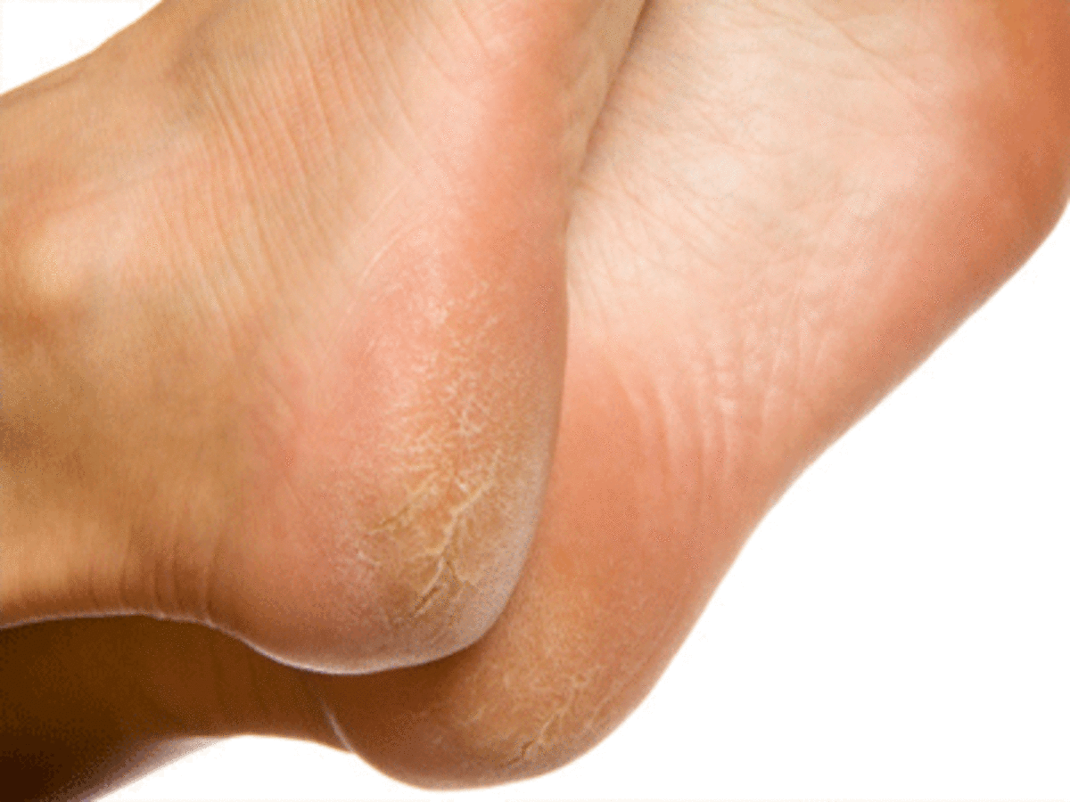 1. Explore how to remove dry skin from feet from causes