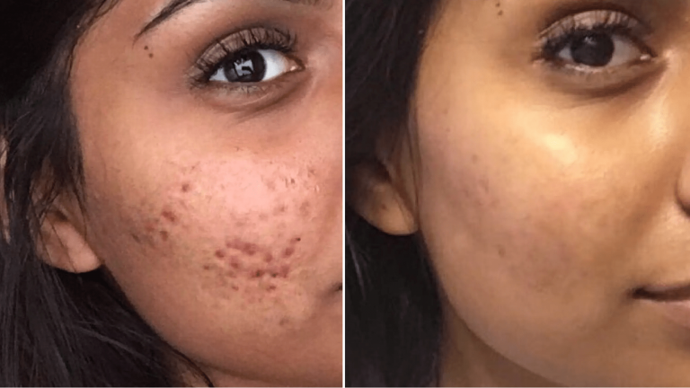 Does glycolic acid help with acne?