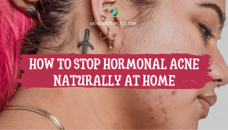 How To Stop Hormonal Acne Naturally At Home