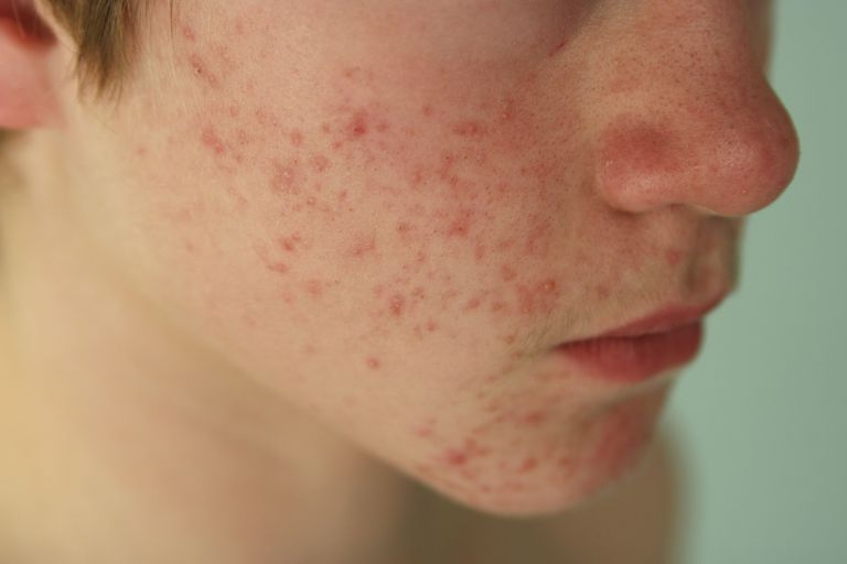 Hormonal acne at adolescence