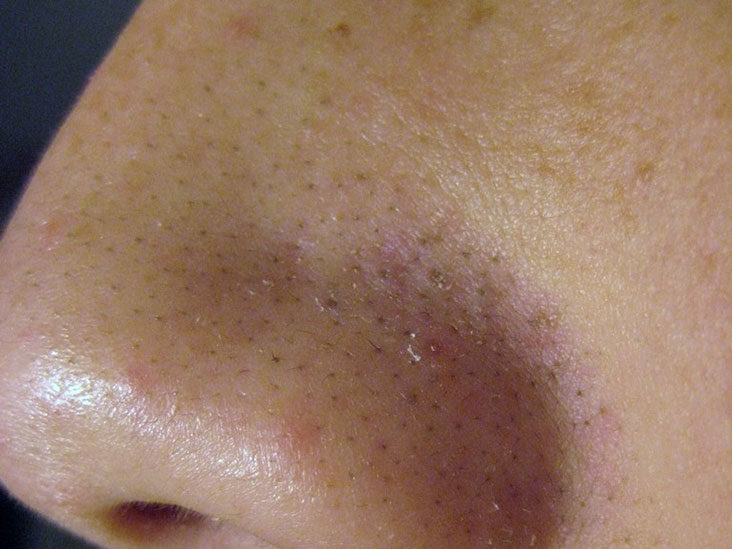 Pores clogged with hard sebum.