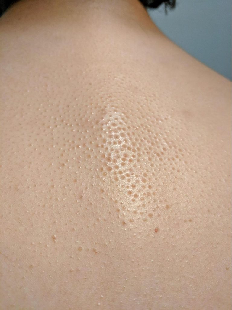 Hard clogged pores on back