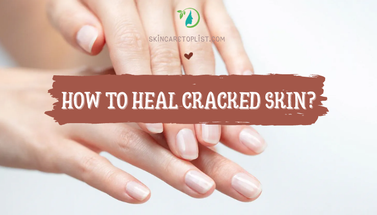 How to Heal Cracked Skin?