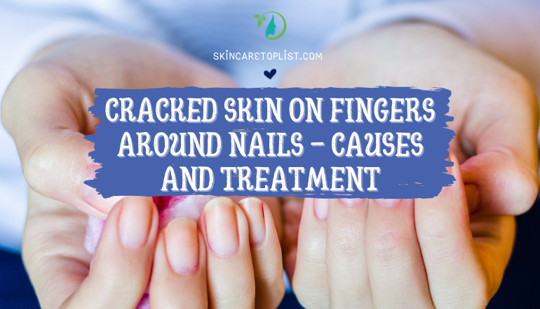 Cracked Skin on Fingers Around Nails – Causes and Treatment