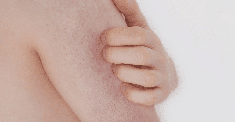 15 Best Body Washes for Keratosis Pilaris That Treat Bumpy Skin