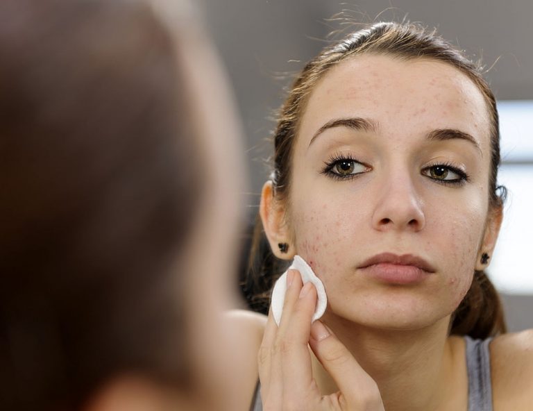 Which Primer Is The Best For Acne-prone Skin?