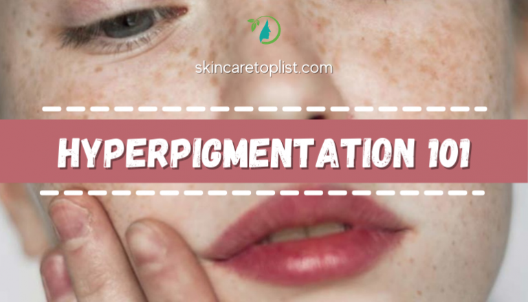 Hyperpigmentation 101- Be Beautiful With Facial Imperfections