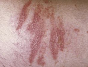 Phytophotodermatitis