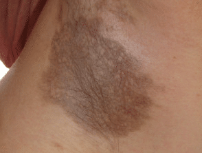 Erythema dyschromicum perstan