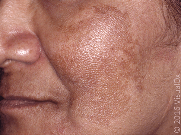 Epidermal melasma