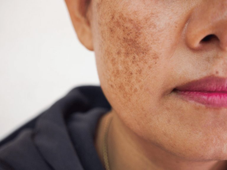 Dermal melasma