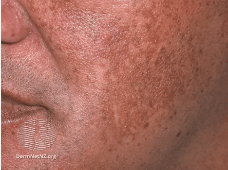 Mixed melasma