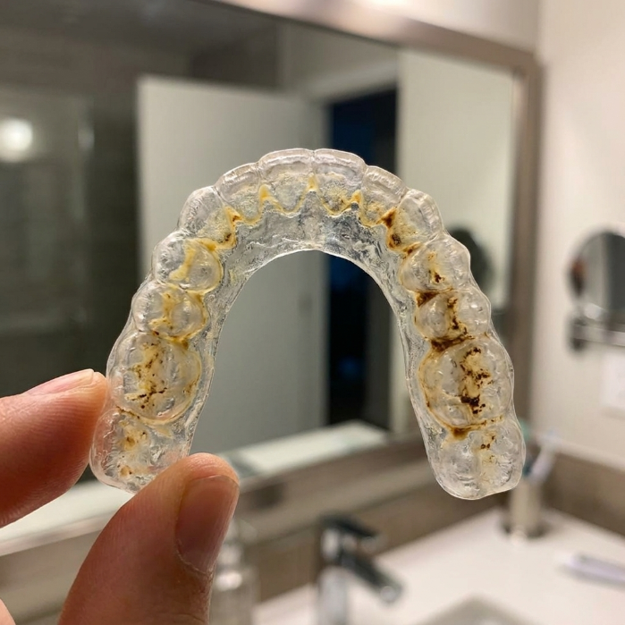 Dirty retainer with yellow bacterial buildup
