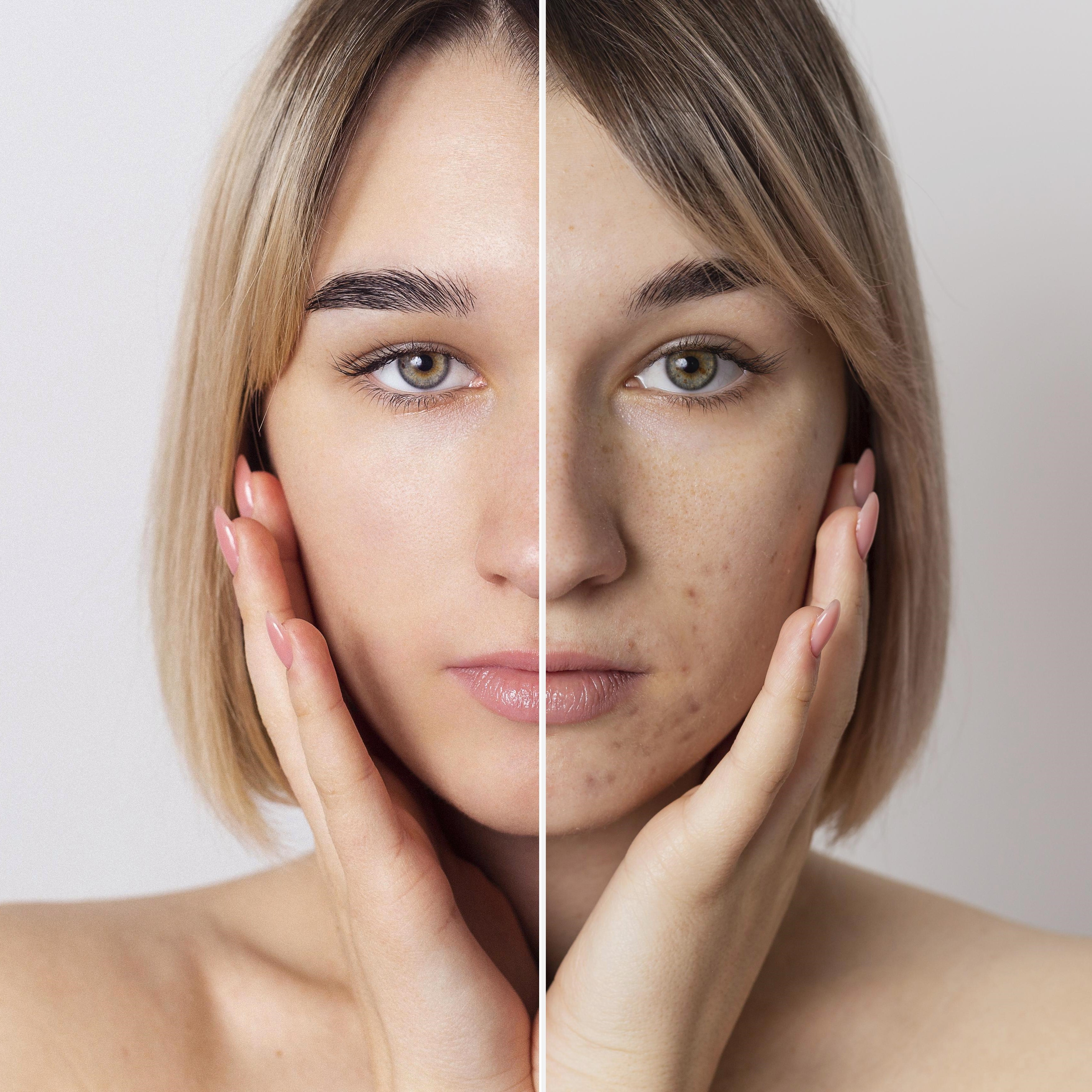 Pigmentation Reduction