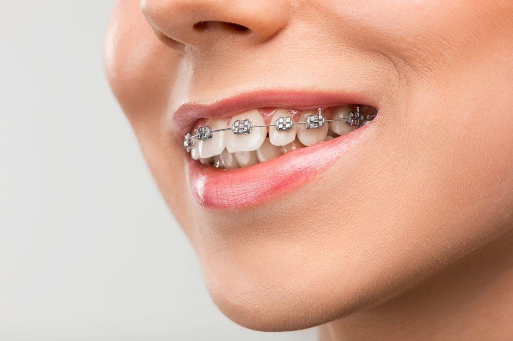Orthodontics (Teeth Straightening/Braces)