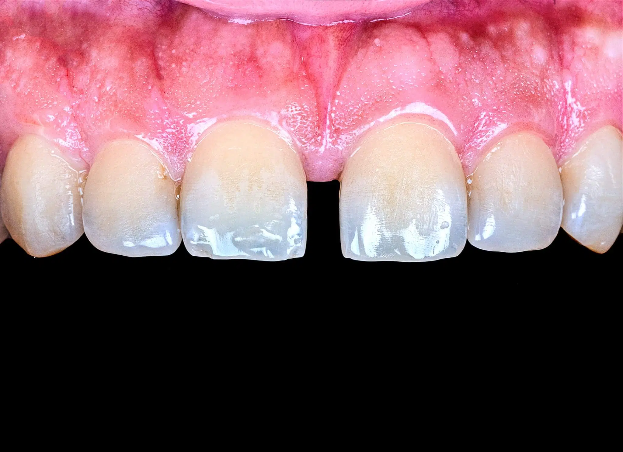 Midline Diastema Closure / Zirconia Veneer