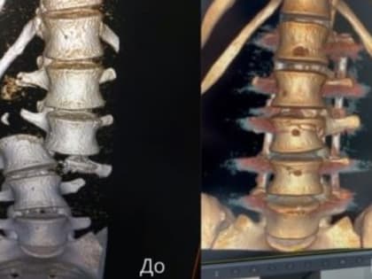 Крымские врачи спасли девушку с тяжелейшим переломом позвоночника