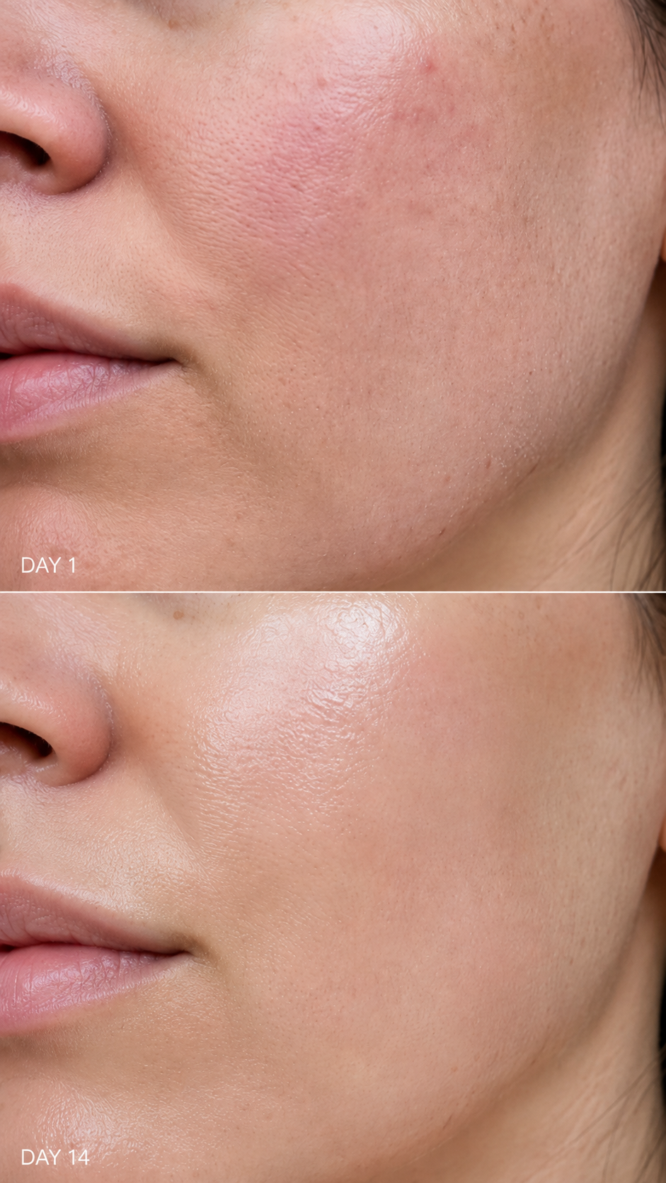 Woman with visible acne