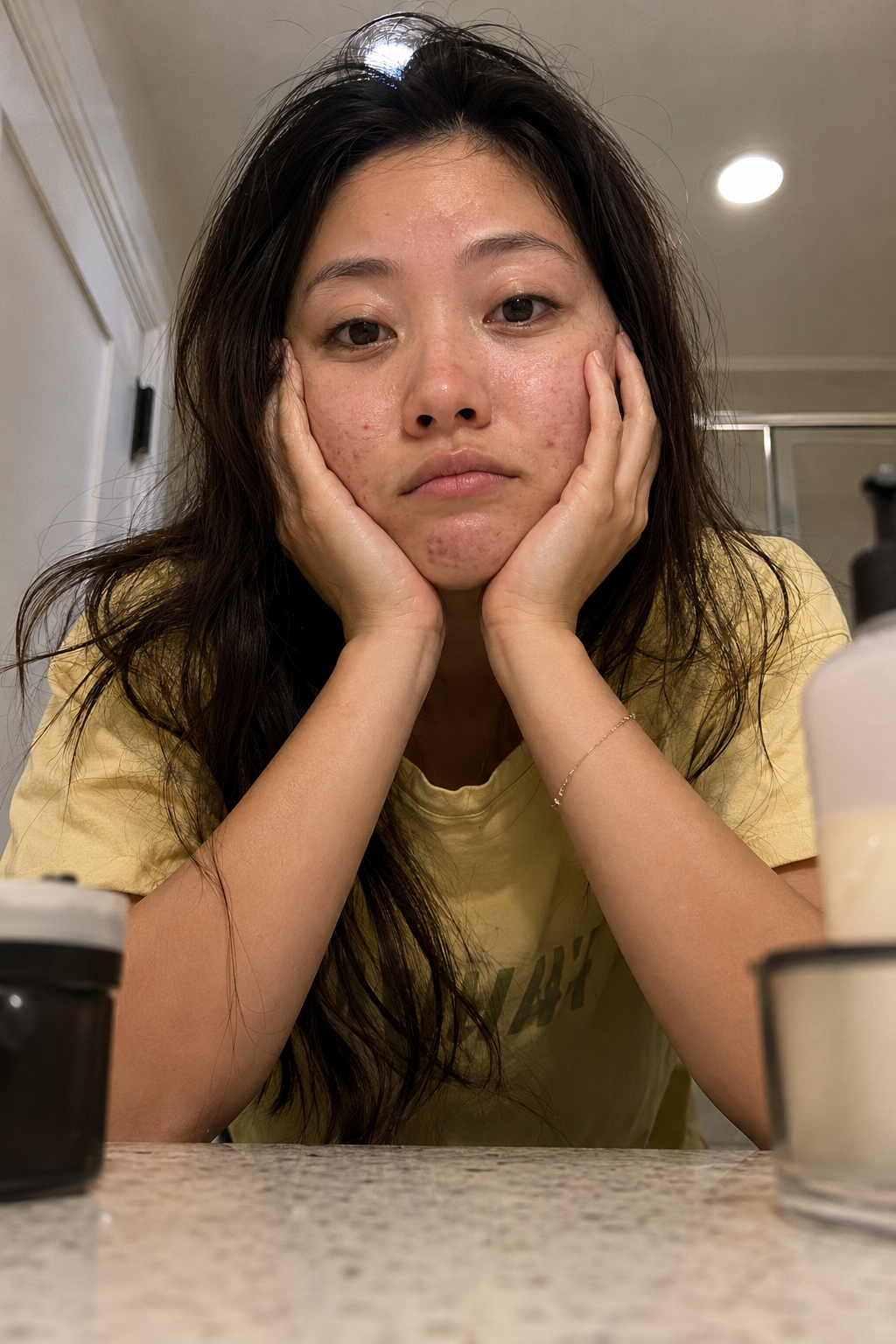 Skin Microbiome Acne Clear Skin Transformation