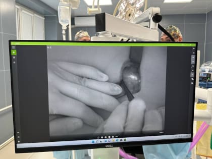 Челябинские онкологи использовали передовую технологию для лечения меланомы