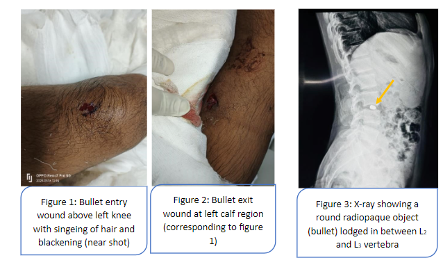 The Significance of Ballistics in Forensic Medicine: A Comprehensive Review 