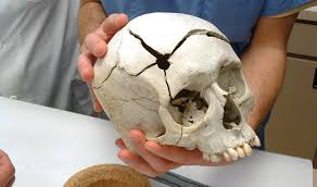 Forensic Anthropology: The Study of Human Bones
