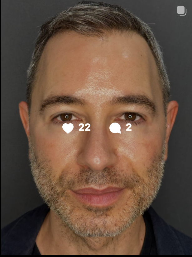 Instagram Image: RF Needling skin tightening results example