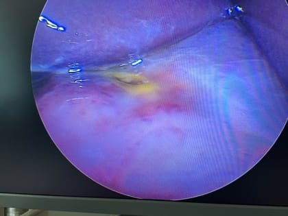 В Балаковской городской клинической больнице врачи сделали уникальную операцию