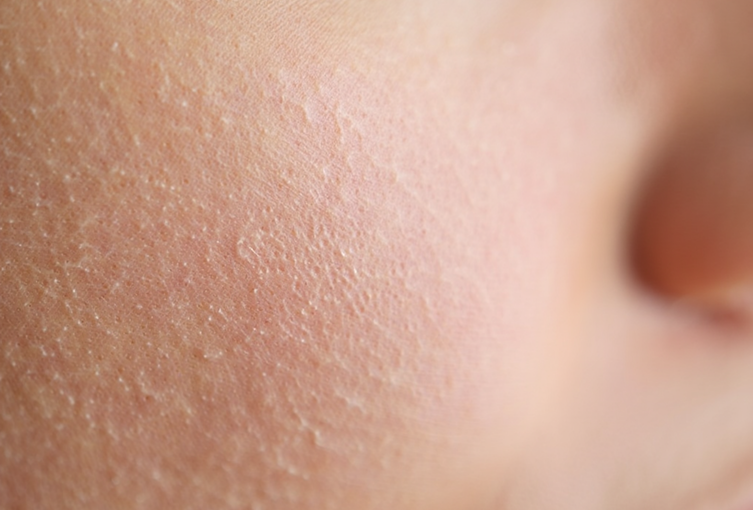 جلد الدجاجة وتوحيد لون البشرة