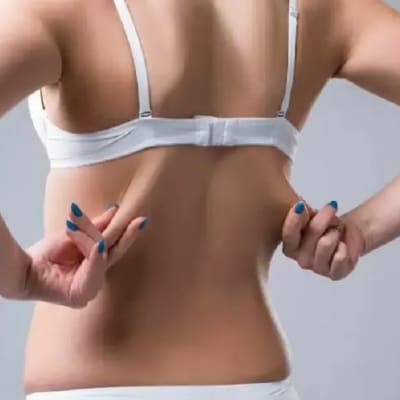 liposuction for back fat