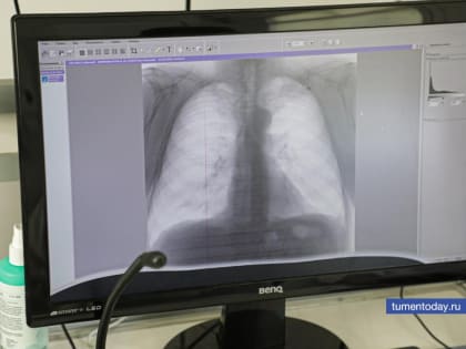 В Тюмени прошла акция по выявлению онкологических заболеваний