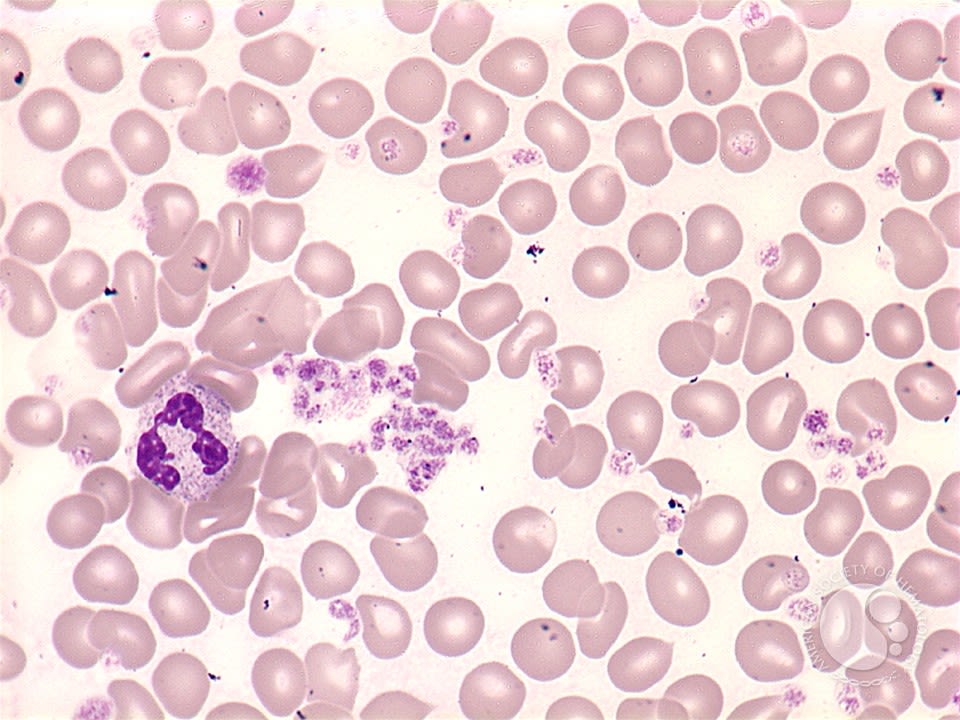 The myeloproliferative blood cancers—essential thrombocytosis (ET