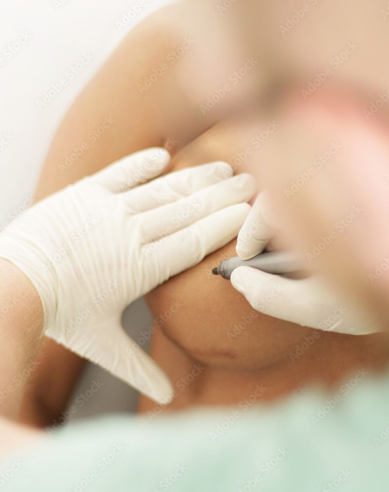 insision marks being made on a breast