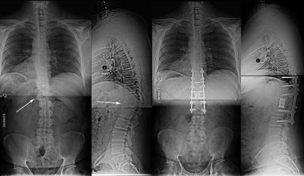 Spine tumor | Dr. Yashpal Singh Rathore | Consultant Neurosurgeon
