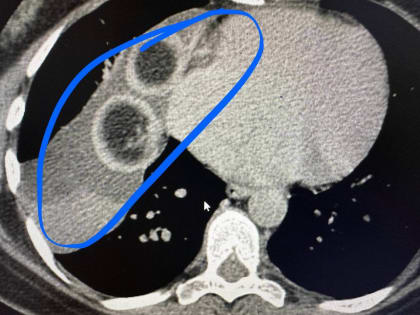 Кисту с клубками волос в грудной клетке удалили хирурги РКБ Татарстана