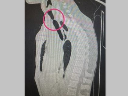 В Казани врачи РКБ впервые произвели стентирование трахеи в рубцах